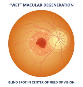 Macular Degeneration South Jersey | Eye Exam Camden County, NJ